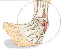 ankle-sprains