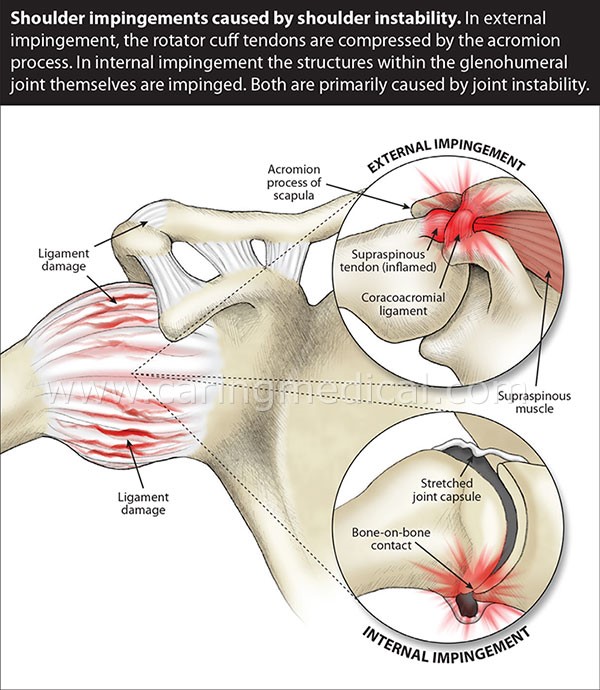 shoulder-injury-external-impingment