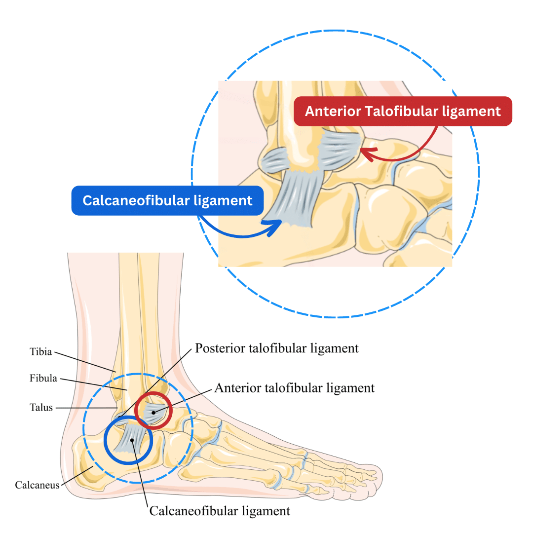 A diagram showing the lateral ankle and it's ligaments, with a close-up identifying the anterior talofibular ligament and the calcaneal-fibular ligament.
